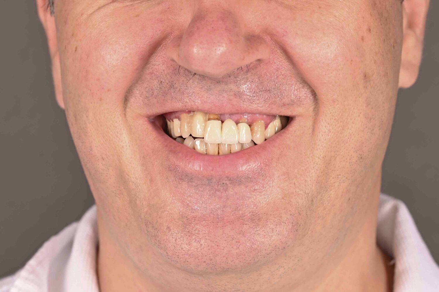 Pacient Clinica Dr. Alin Odor - Rezultat Implantologie